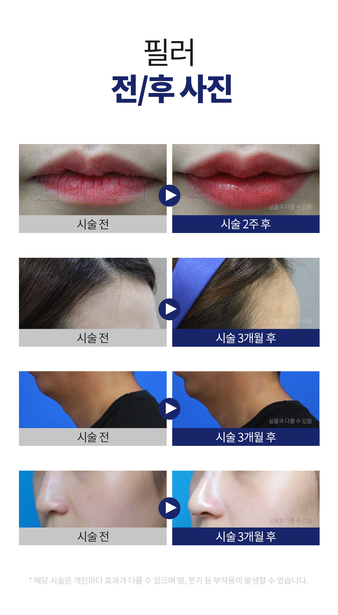 필러 - 강남 미앤미 의원